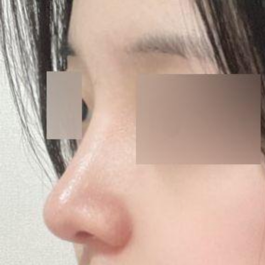 Би Веверсээс мэс ажилбар хийлгээд 3 сар болжээ хэхэ