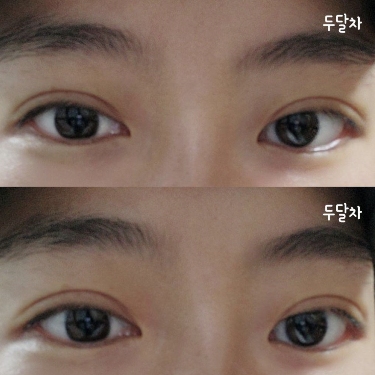 Нүдний мэс заслын дараах 2 сарын бодит сэтгэгдэл~^^