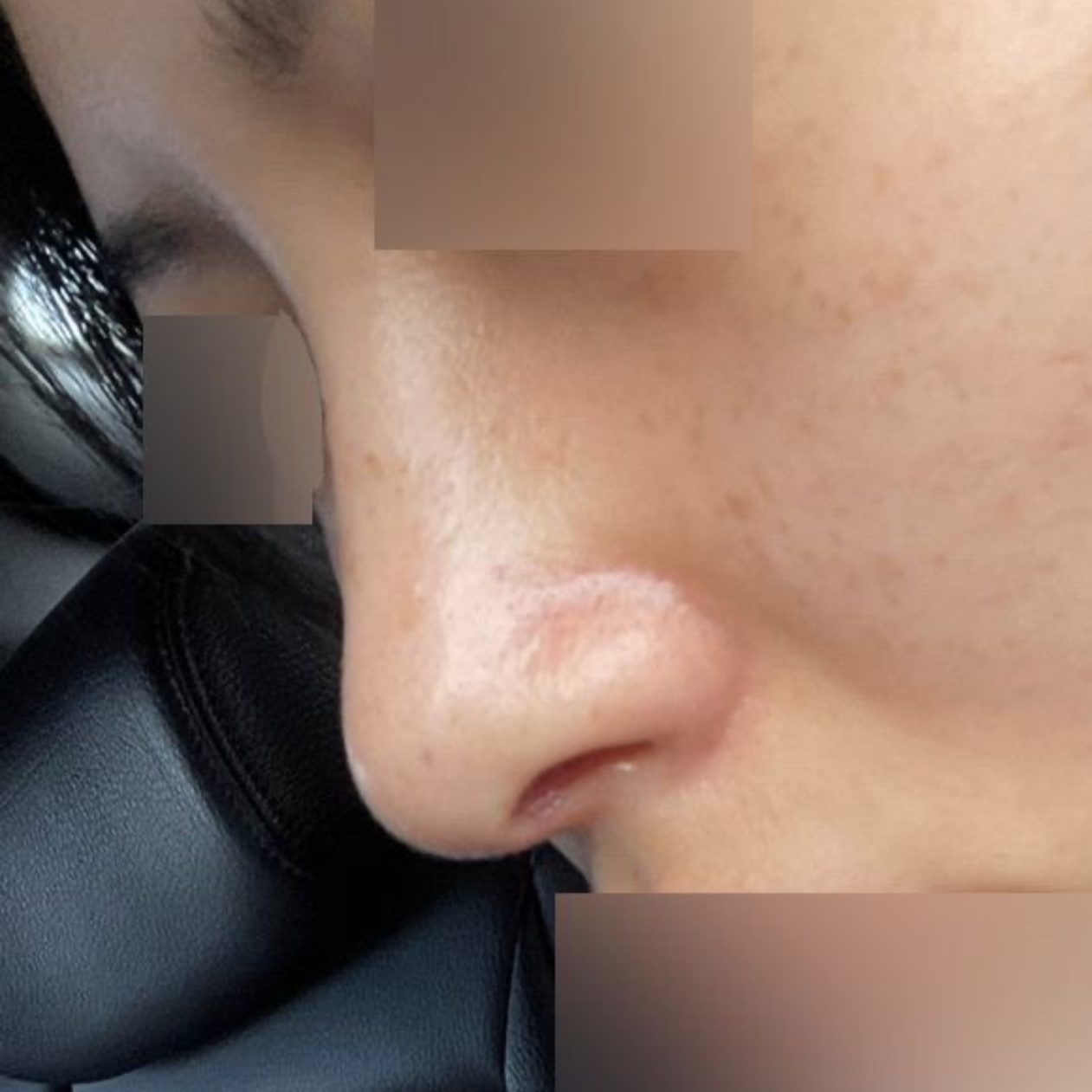 Би протезгүй хамар заслын хагалгаанд орсон