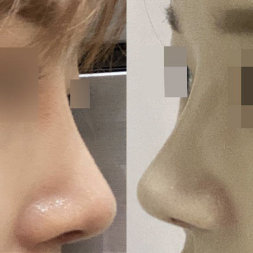 Хамрын мэс засал хийлгэснээс хойш 3 сар өнгөрчээ