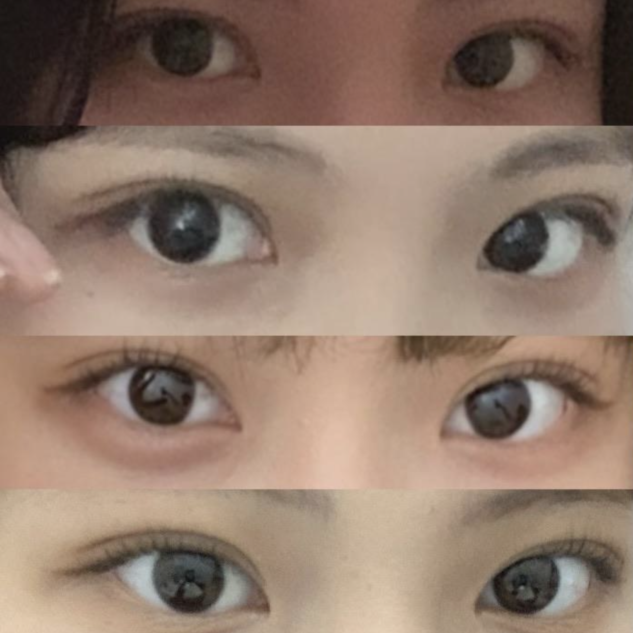 (Байгалийн наалдацтай нүдний хэлбэр засах урд зүсэлт) хагалгаанд орсны дараах 4 сар