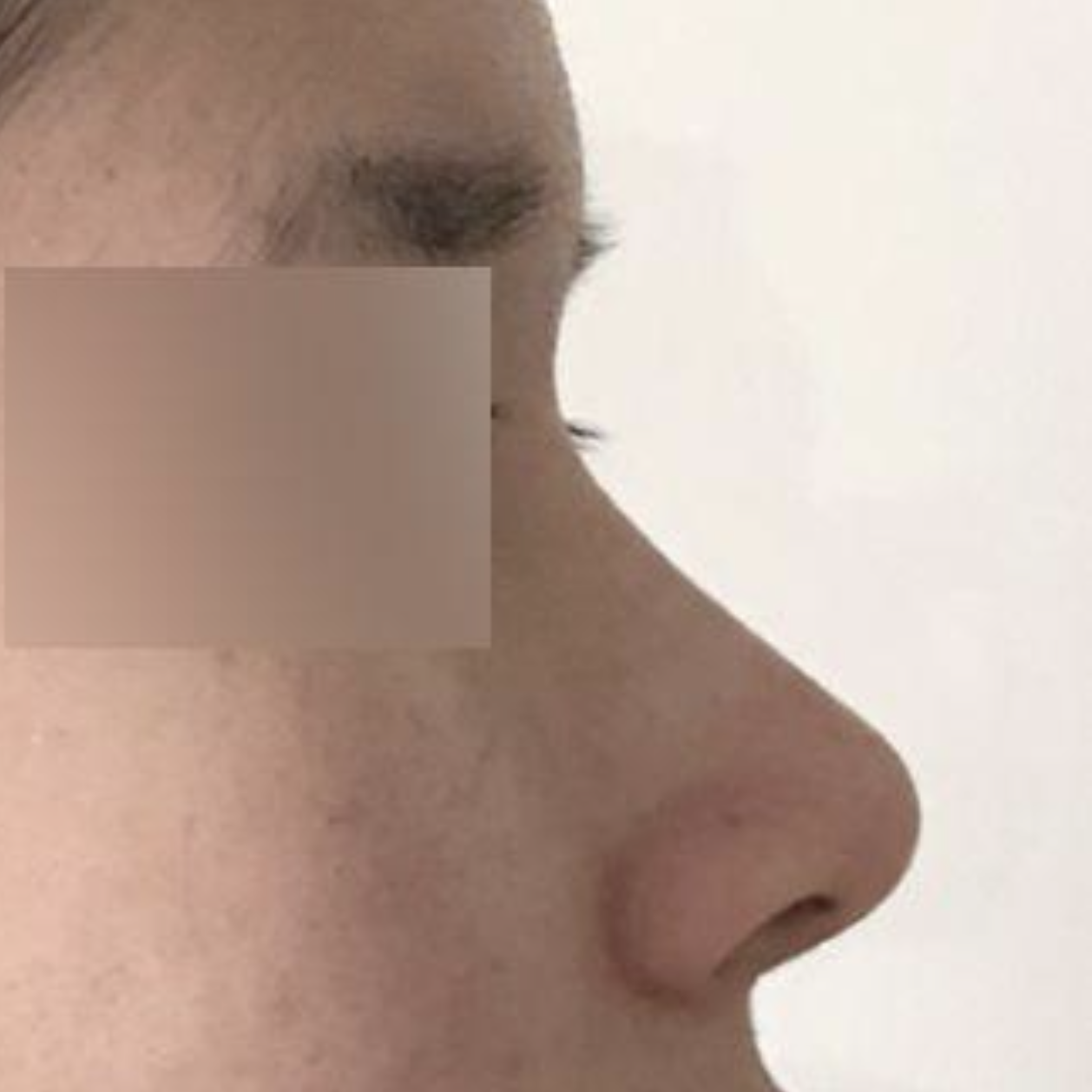 Хамрын мэс засал хийлгэснээс хойш 3 сарын дараах сэтгэгдэл!