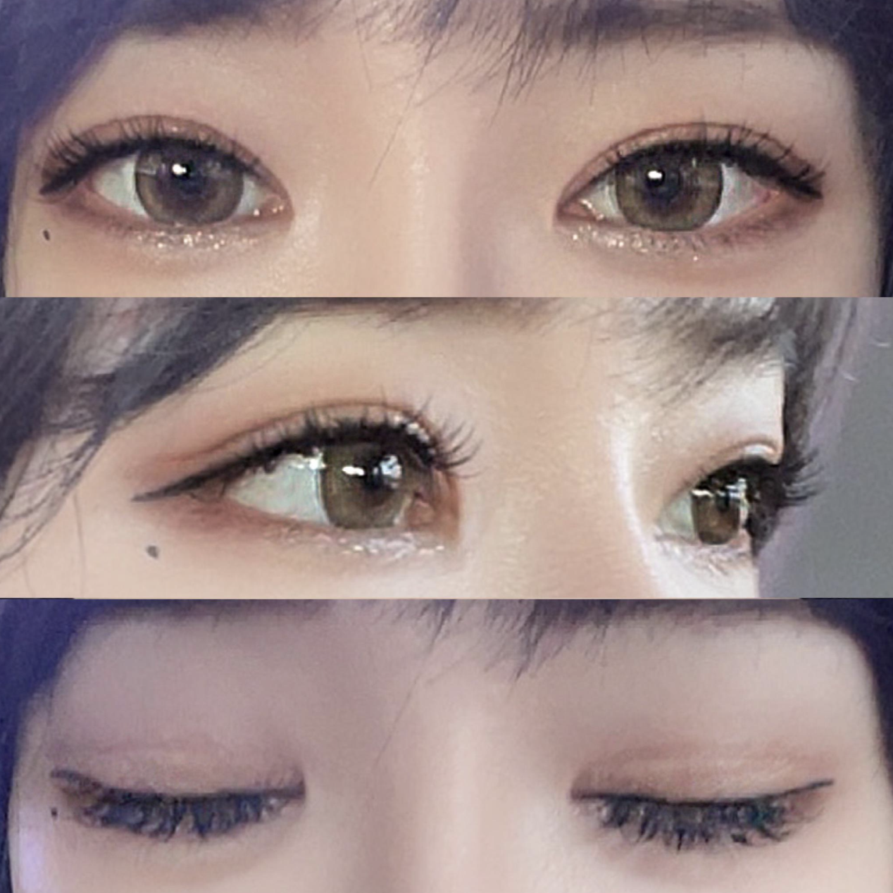 Нүдний дахин хагалгаанд ороод 4 сар өнгөрчээ.