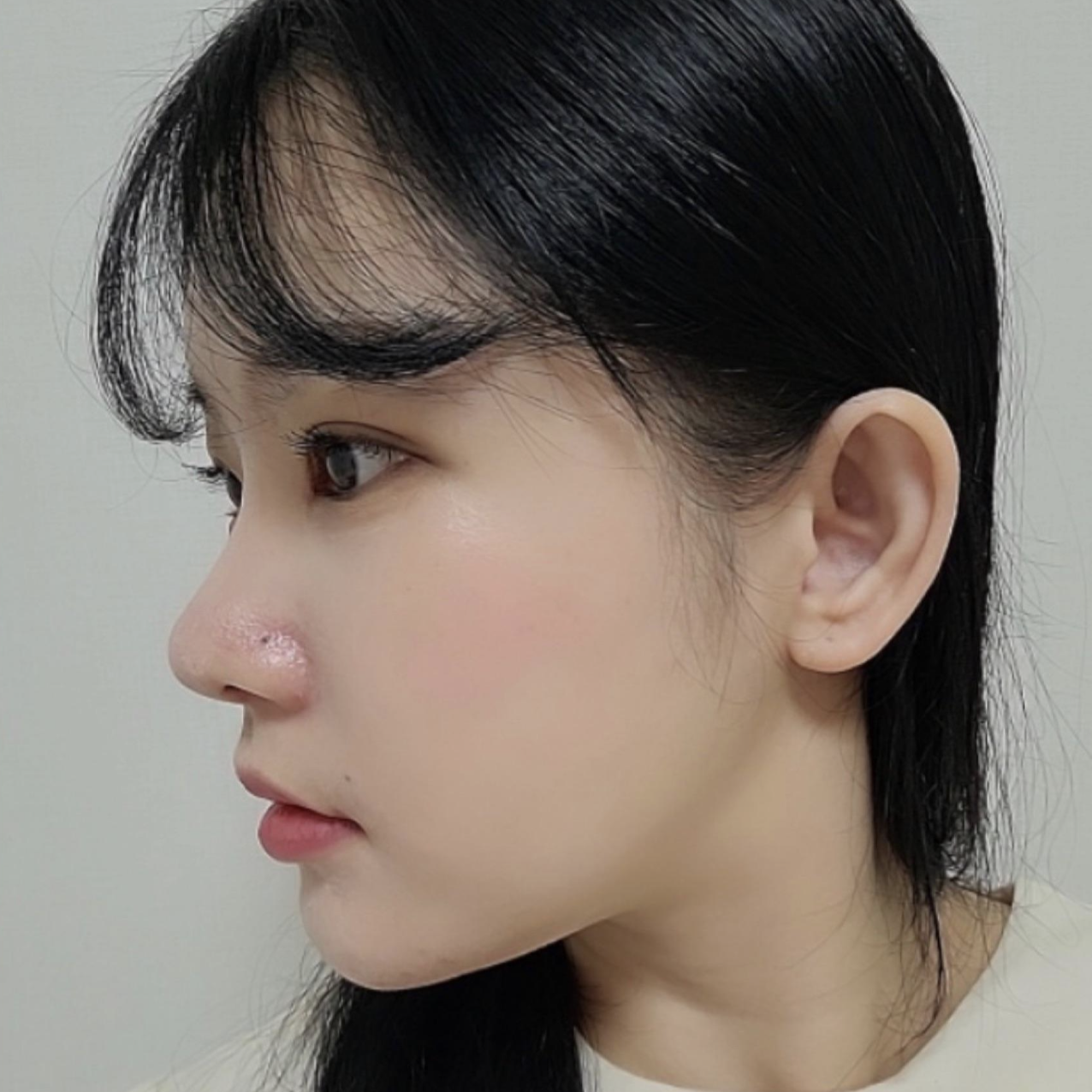 Нүд, хамрын дахин хагалгаанд орсны дараа 1 сар боллоо