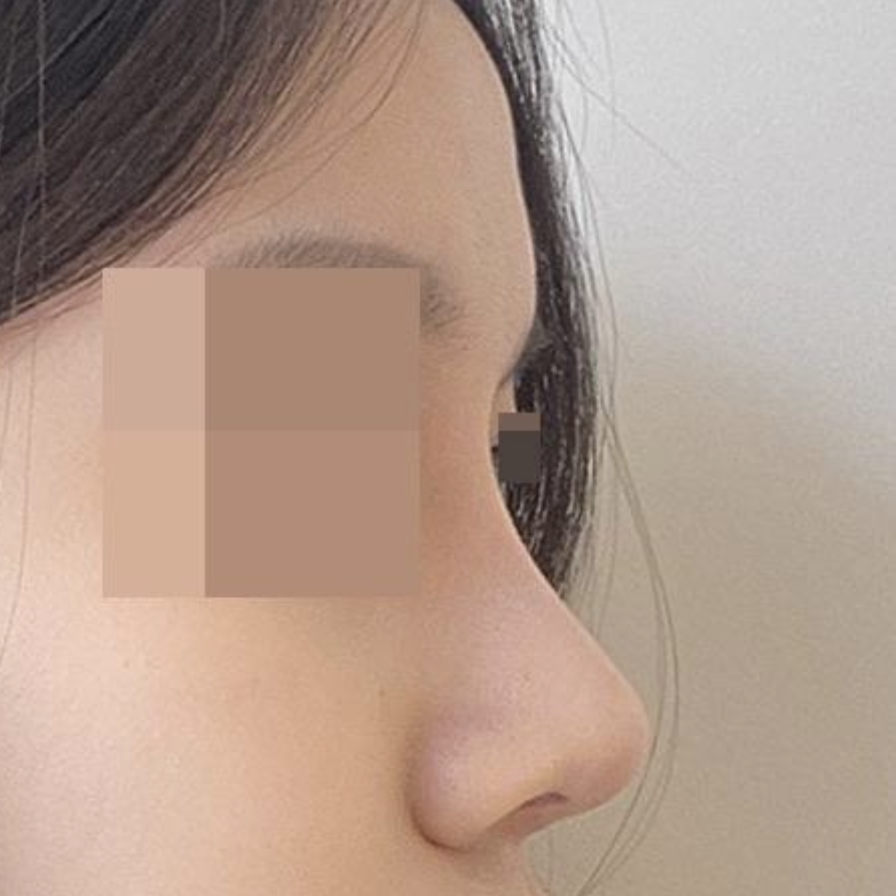 Хамрын мэс заслын дараах 3 сарын тойм!