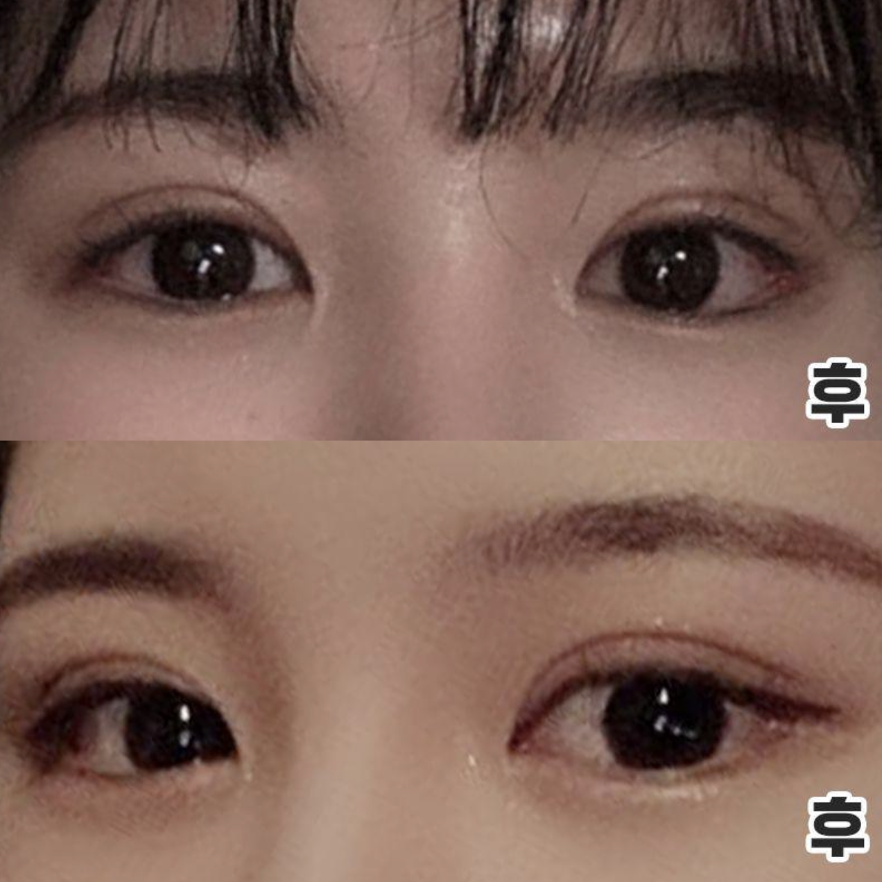 Нүд хөндлөнгөөрөө урт болсон! Давтан мэс заслын дараах амжилт