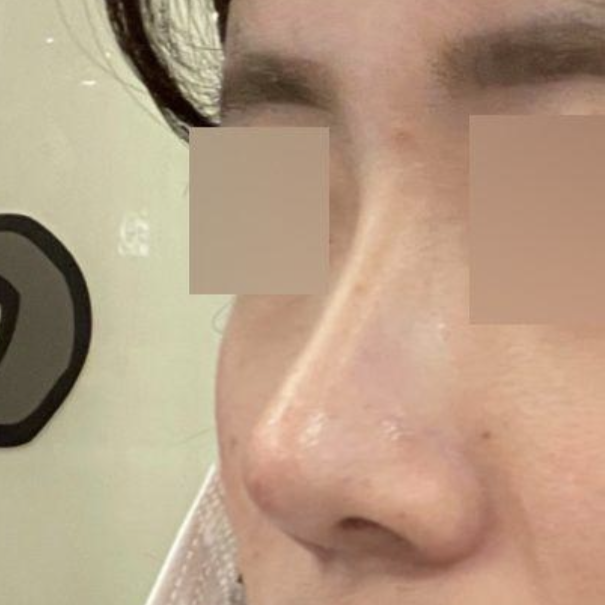 Хамрын мэс засал хийлгэснээс хойш хоёр сар боллоо!