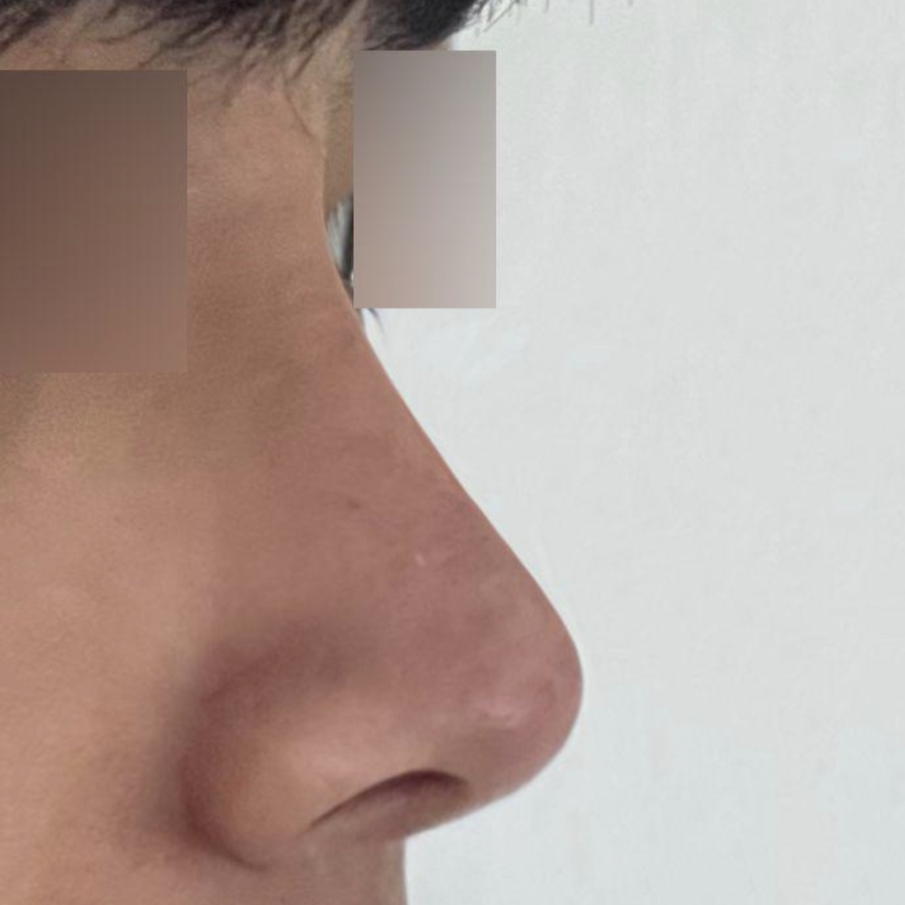 Бөмбөгөр хамартай хагалгаанд ороод 3 сар боллоо.