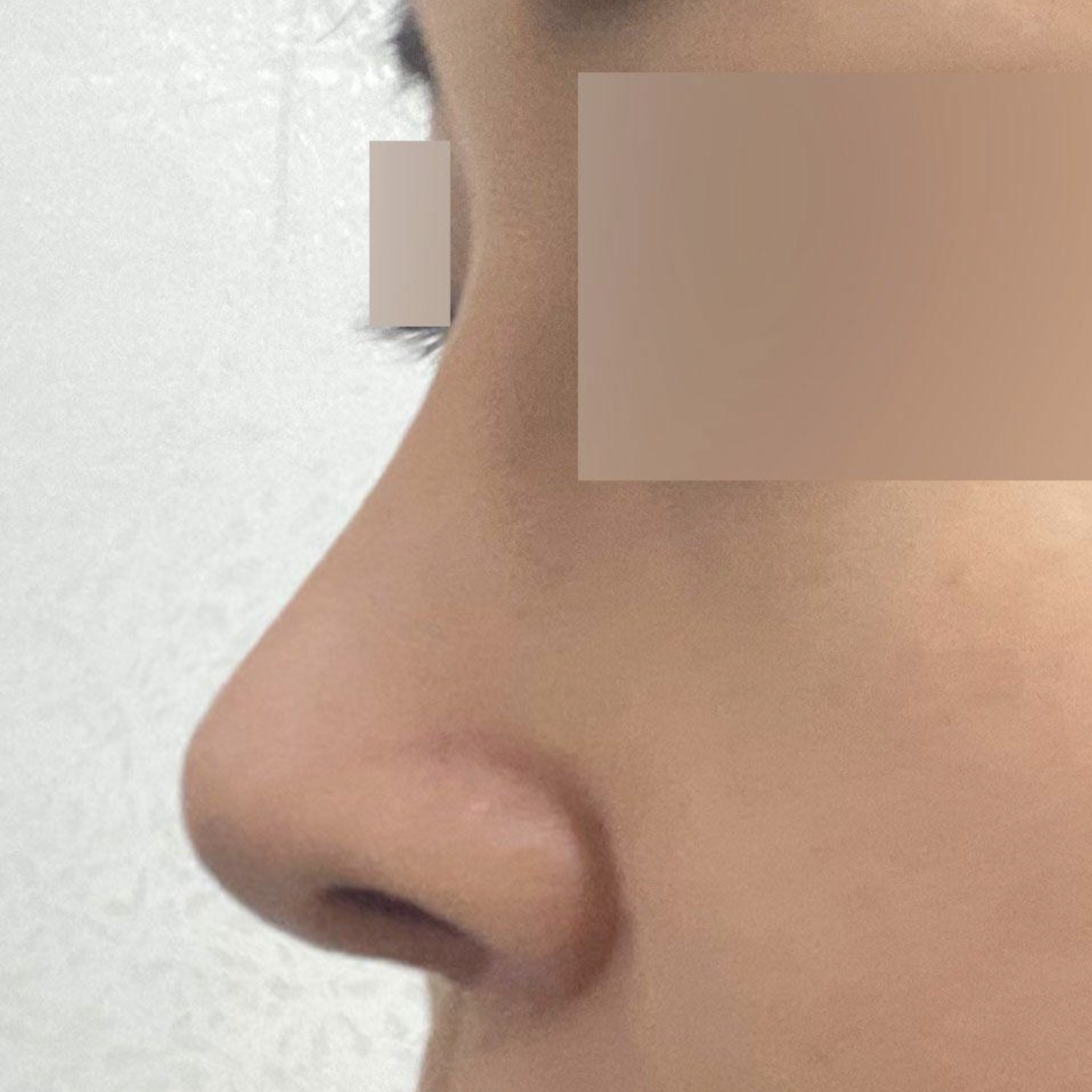 Хавчуулсан хамартаа дахин хагалгаа хийлгэлээ