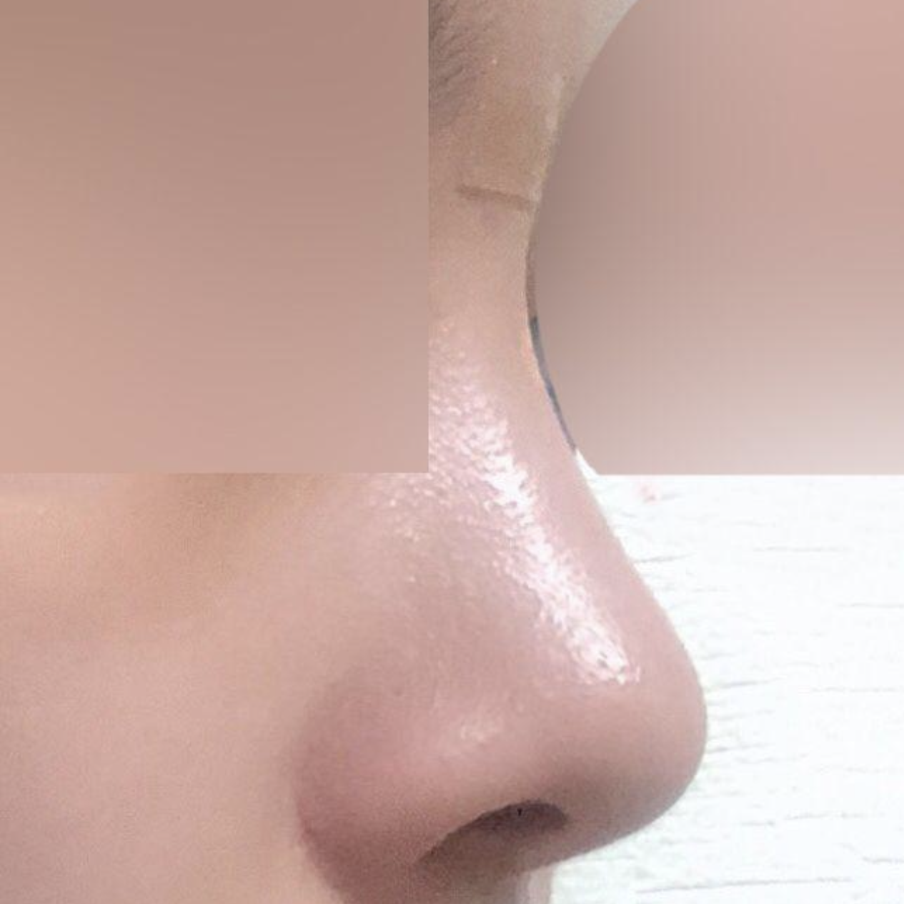 Хамрын мэс заслын дараах 3 сарын тойм