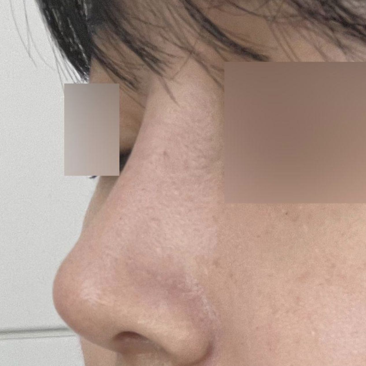 Хамрын мэс засал хийлгэсний дараах нэг сарын тойм: Амжилттай боллоо!