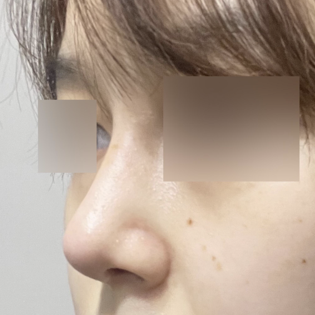 Вийвэрс гоо сайхны мэс заслын эмнэлэгт хамрын дахин мэс засал хийлгэсний дараах нэг сарын дараах сэтгэгдэл~! 