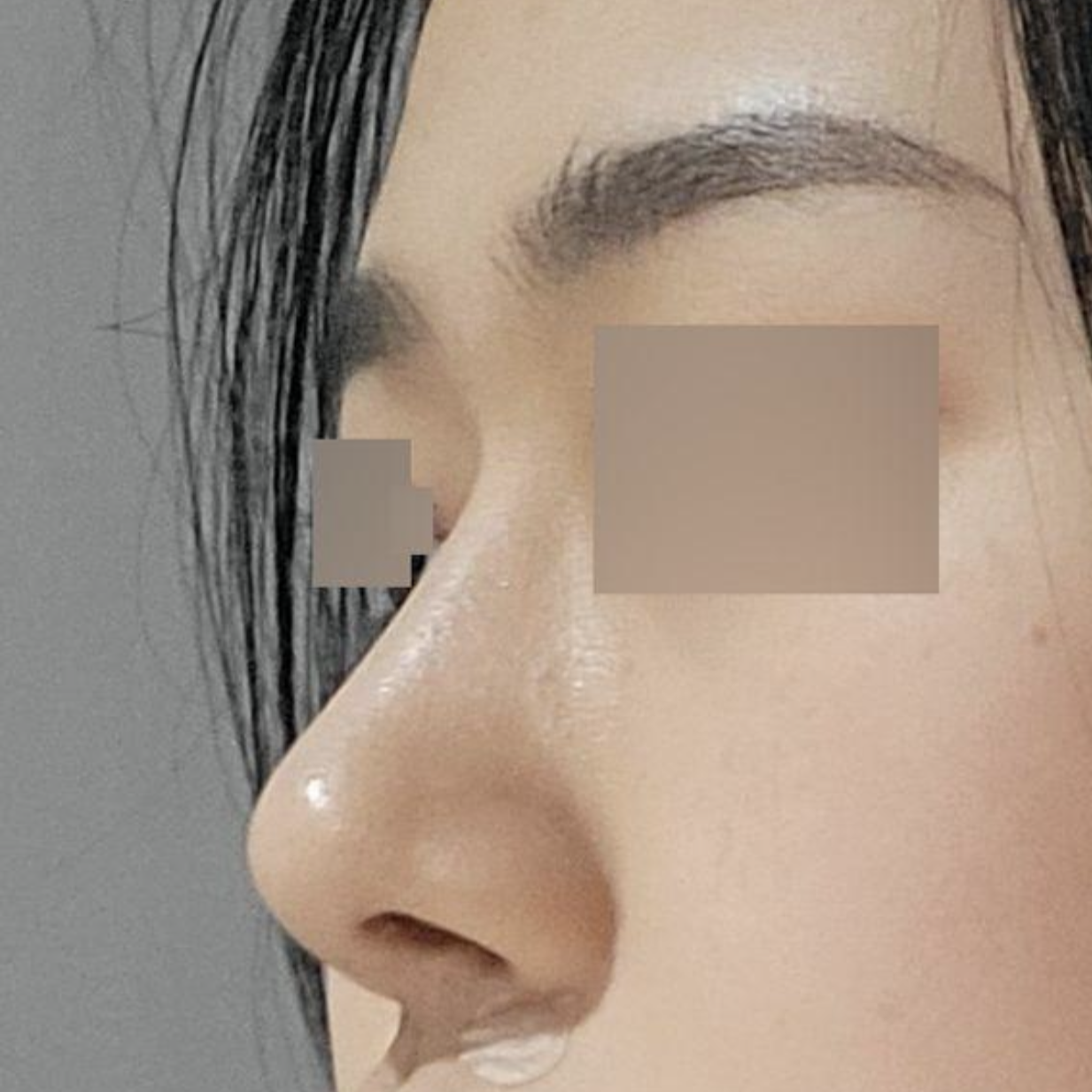 Би Виверсэд мэс засал хийлгэснээс хойш 5 сар болж байна