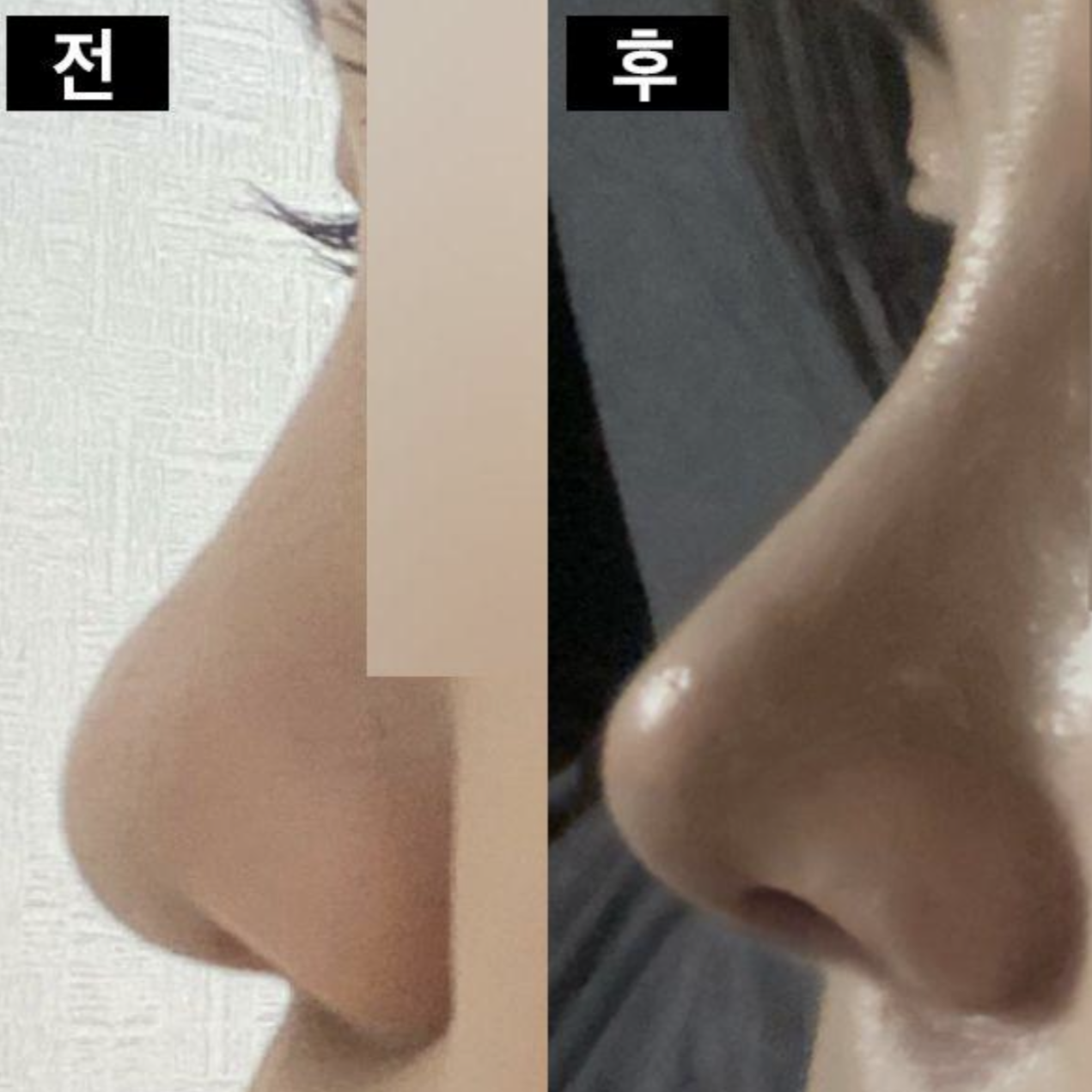 Хамрын мэс засал хийлгээд сар болж байна даа хэх