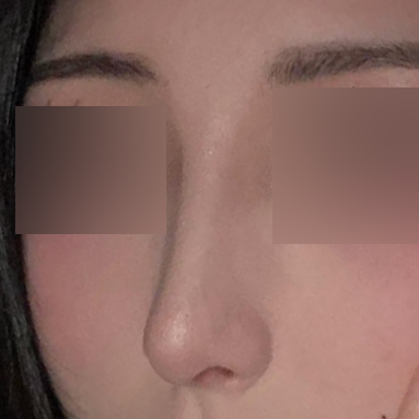 Би шувуун хамартаа стресстэж, шийдээд хагалгаанд орсон!!