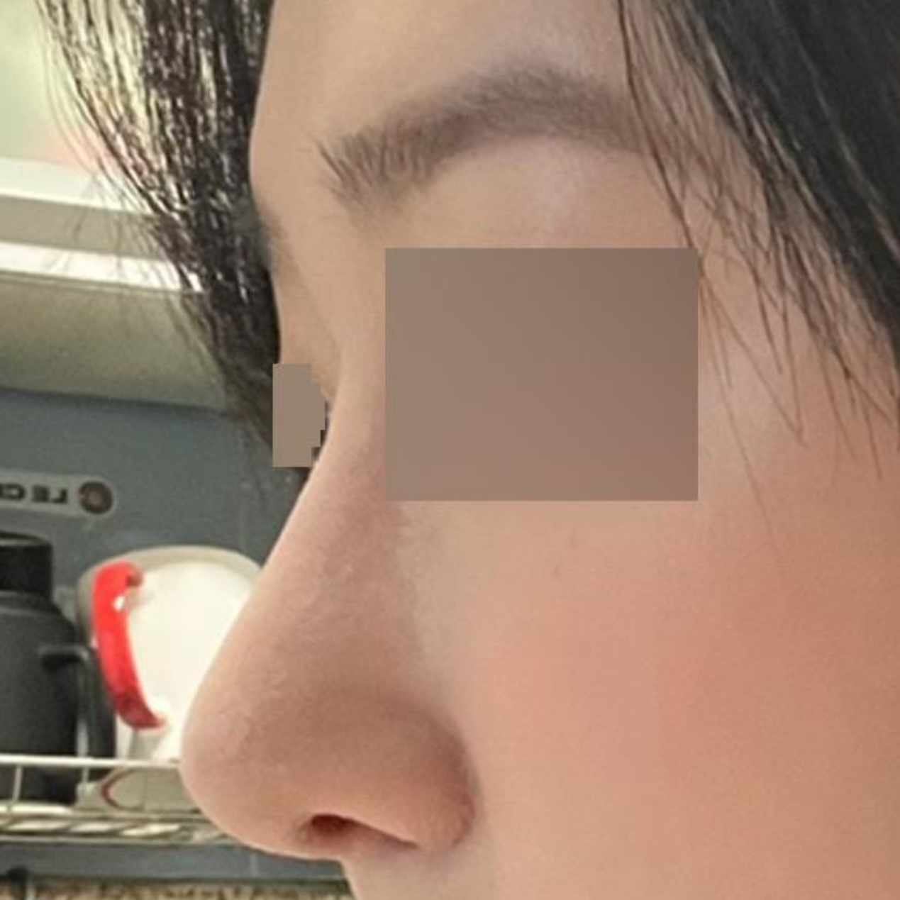 Анхны хамар заслын мэс засалд энд тэндгүй санаа зовж байгаад эцэст нь хамар засууллаа.