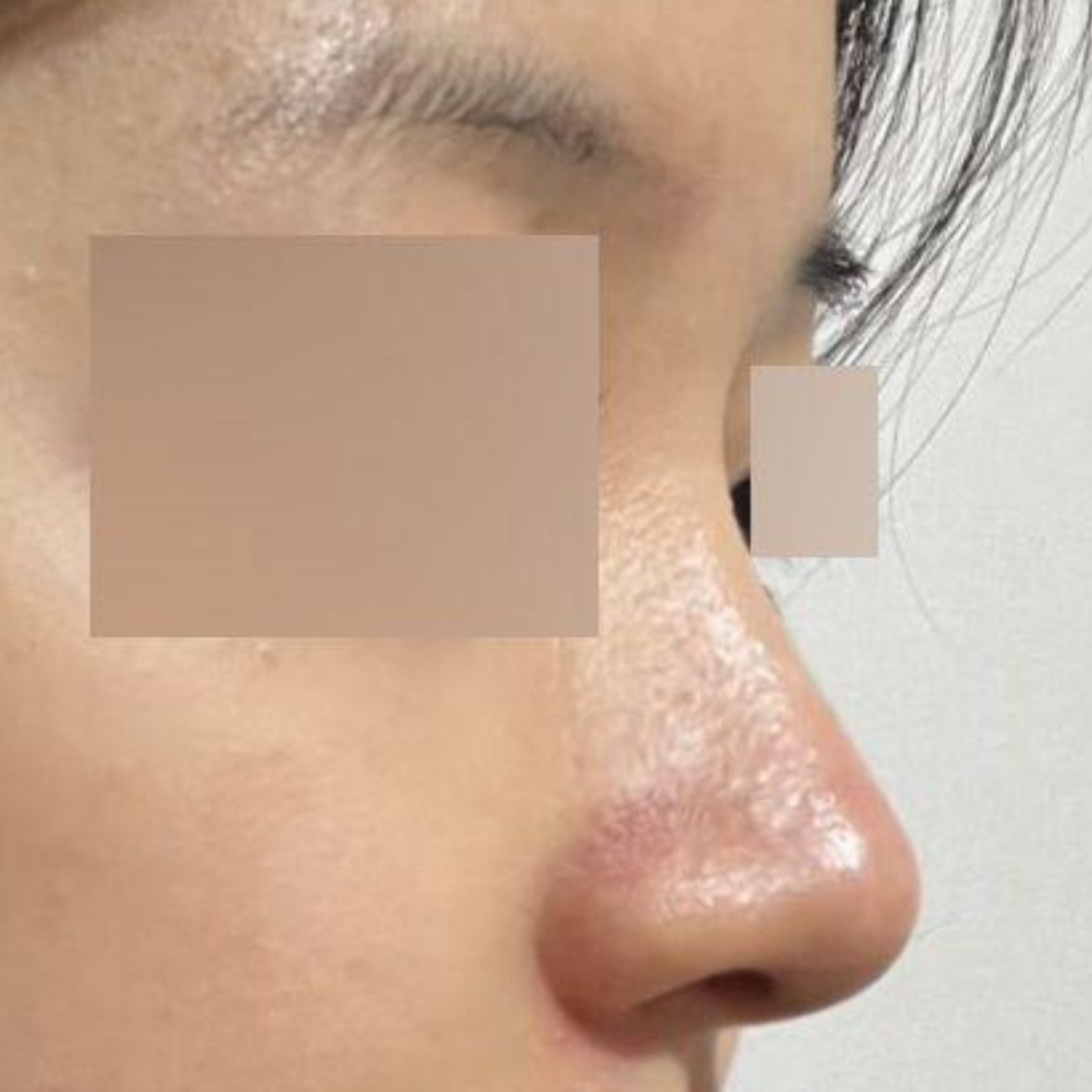 Хамрын мэс засал хийлгэснээс хойш хагас жил болжээ хэхэ