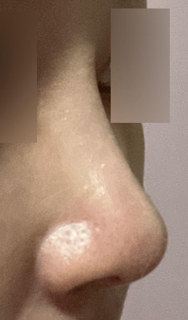 Мэс засал хийлгээд 6 сар болжээ