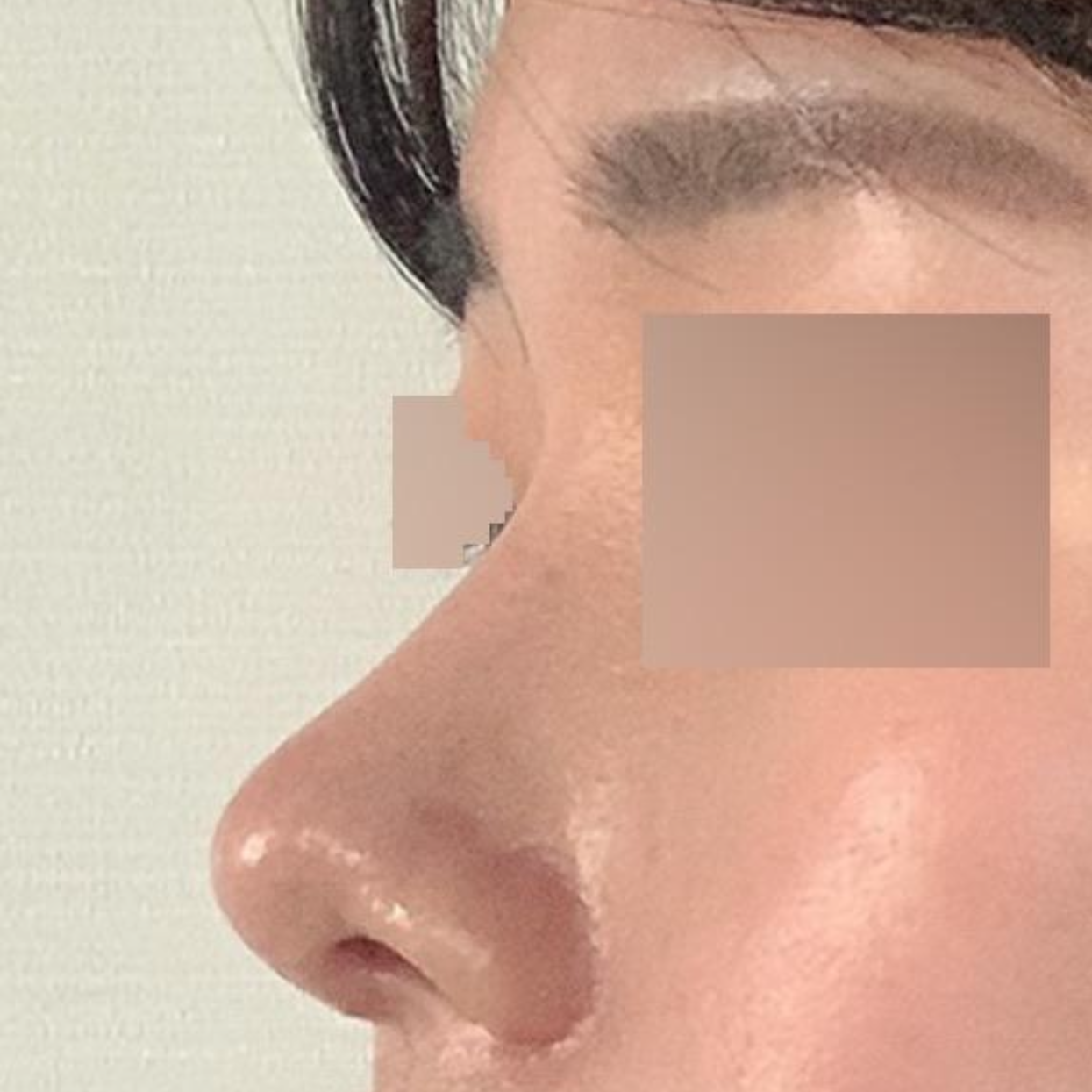 Вийверс гоо сайхны мэс заслын эмнэлэгт нүд, хамрын хагалгаанд орсноос хойш нэг сарын дараах сэтгэгдэл!!