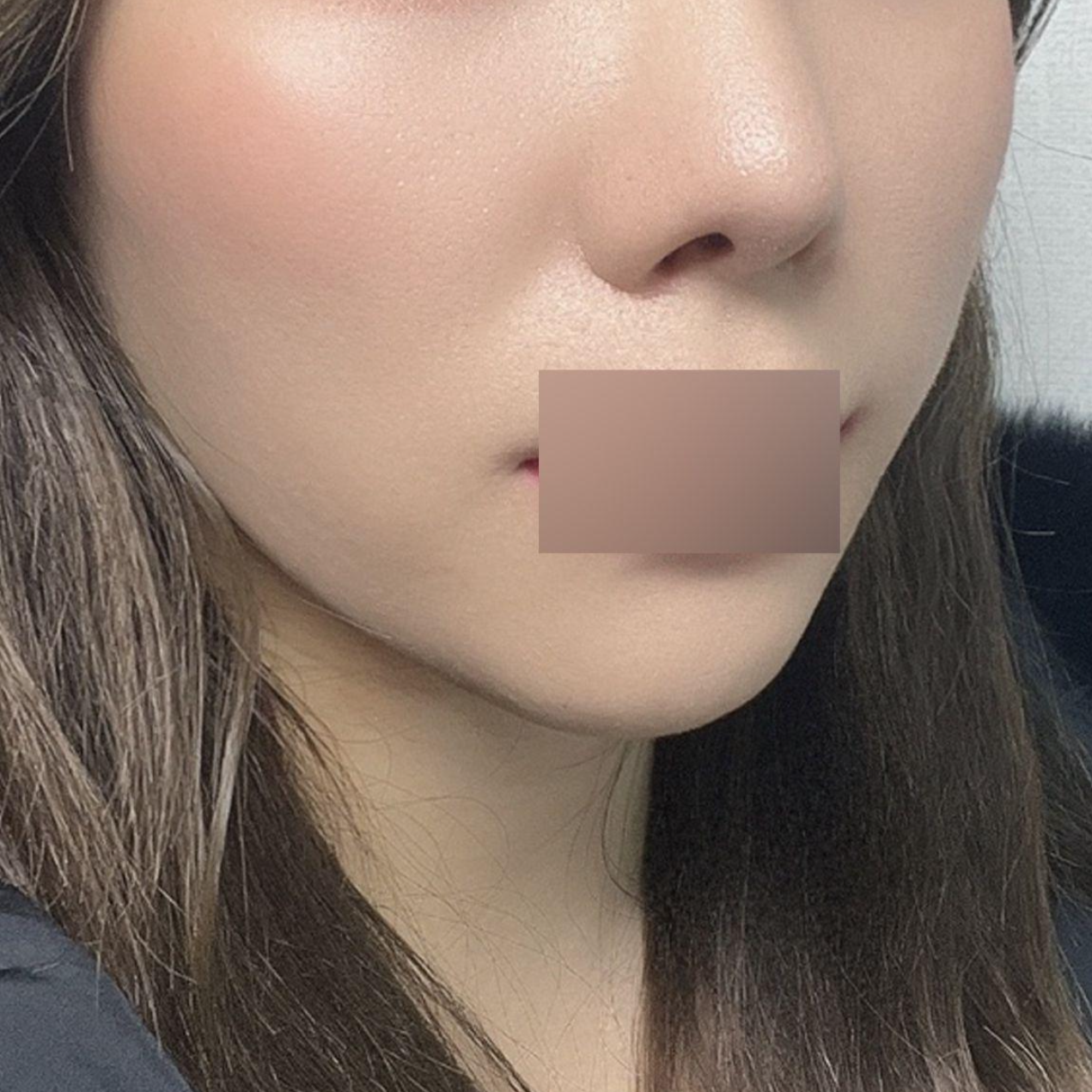 Гоо сайхны мэс заслын Peach Thread Lift хийлгэснээс хойш 3 сар боллоо