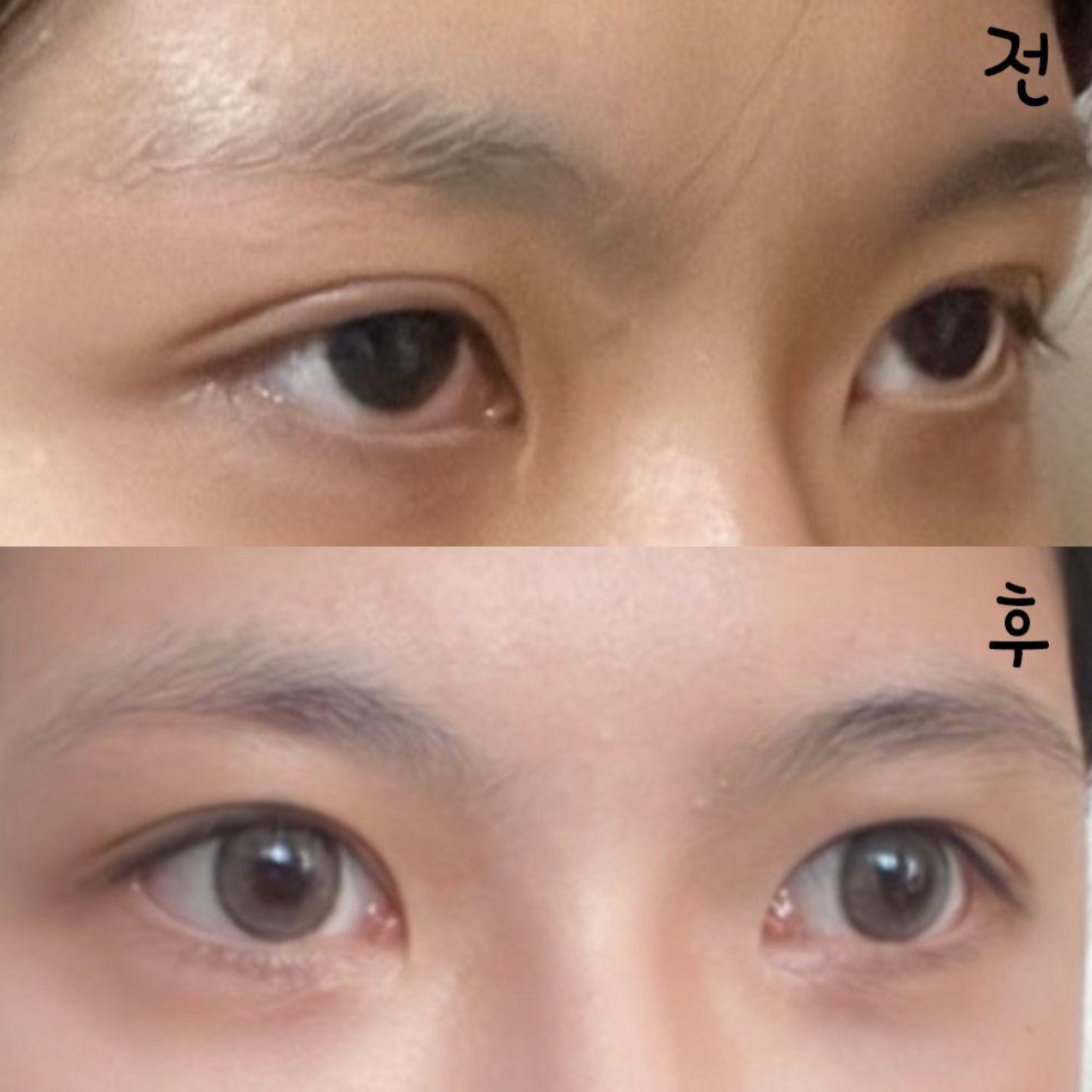 Ганнам дүүргийн Weavers гоо сайхны мэс заслын эмнэлэгт нүдний дахин мэс засал хийлгэснээс хойш хоёр сар болж байна!