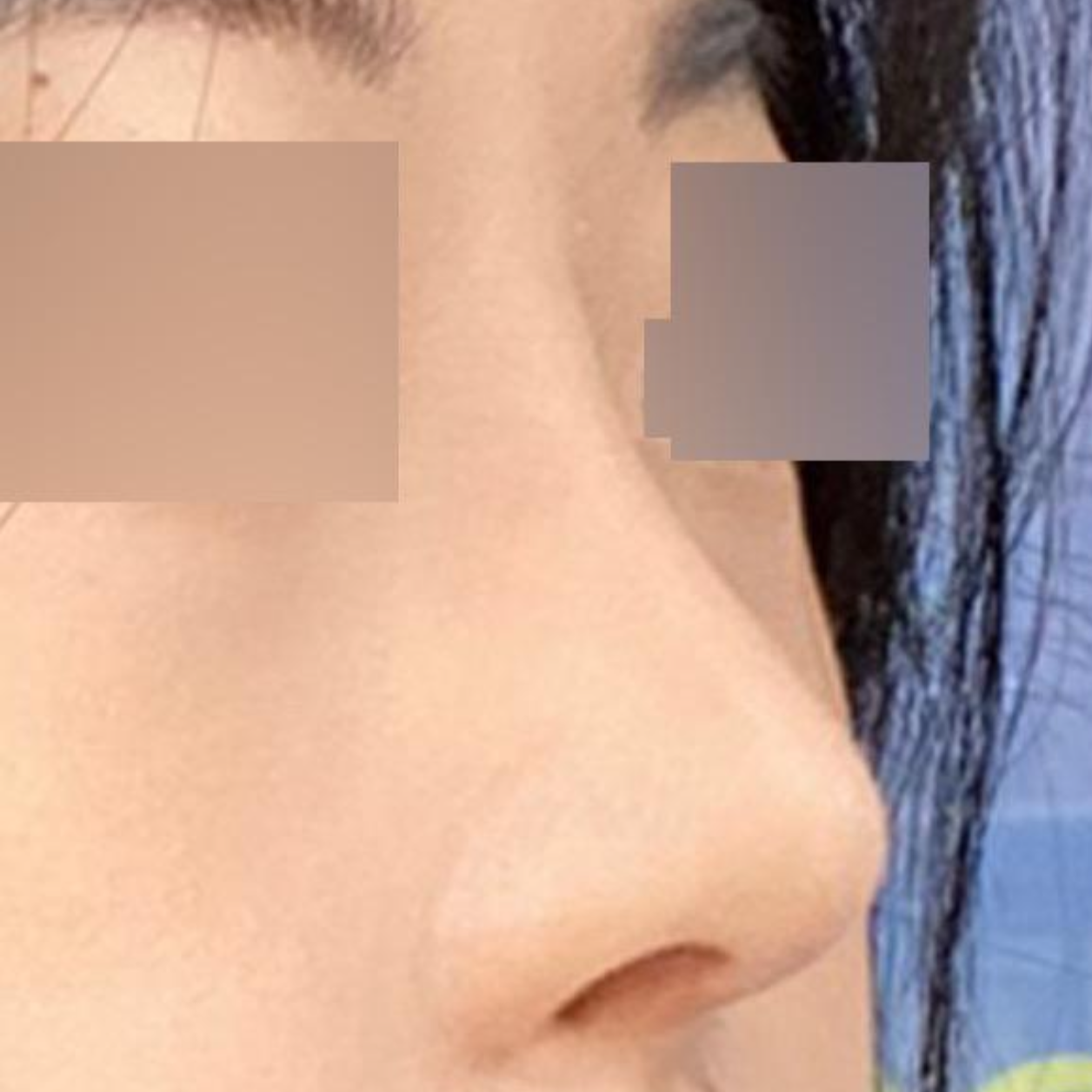 Мэс засал хийлгэснээс хойш 2 сар болж байгаа ч үнэхээр сэтгэл хангалуун байна.