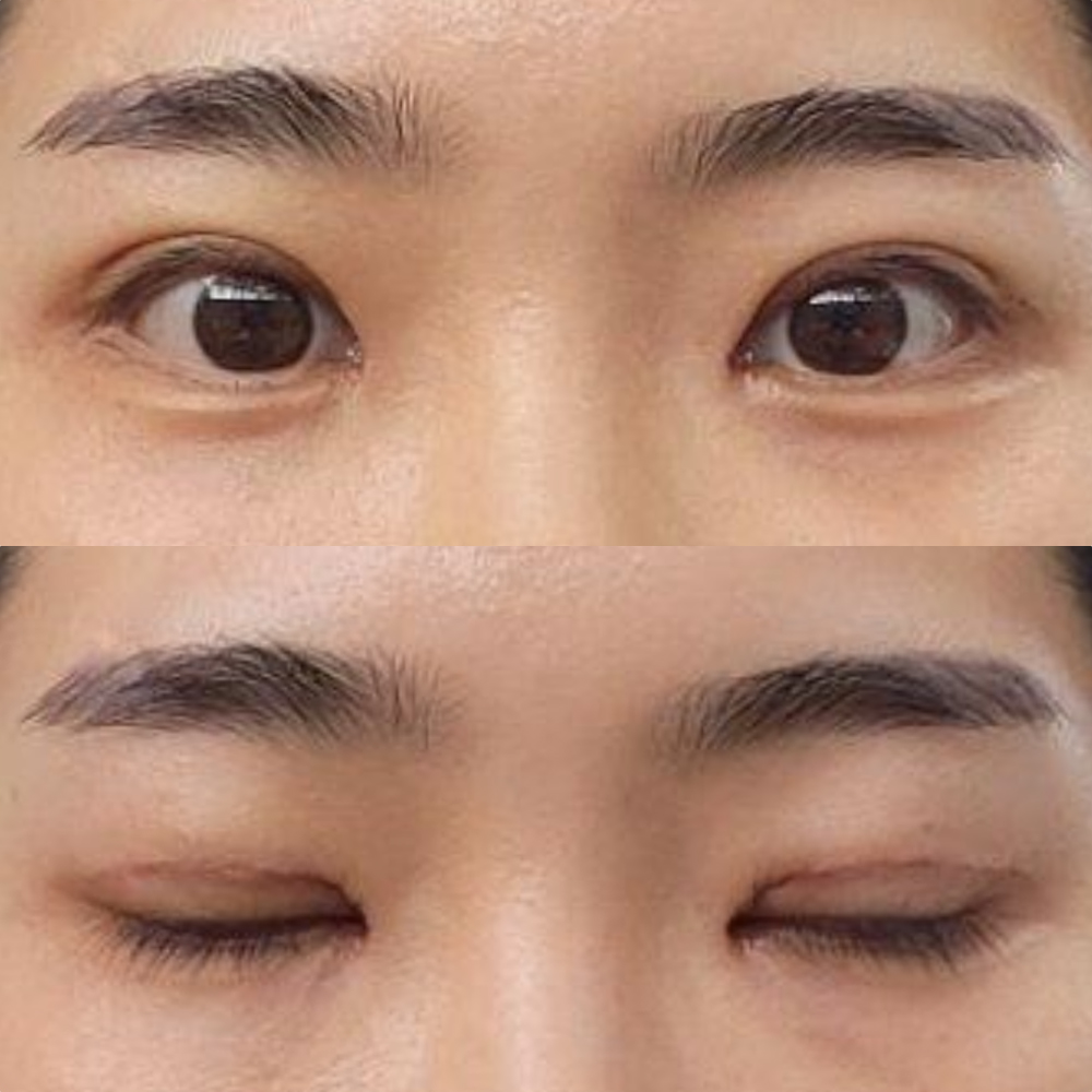 Нүдний дахин хагалгаа хийлгэснээс хойш долоо хоног боллоо