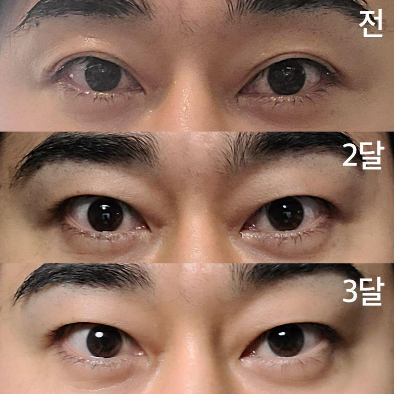 Давхар зовхины зүсэлт хийлгэснээс хойш 3 сар болж байна.