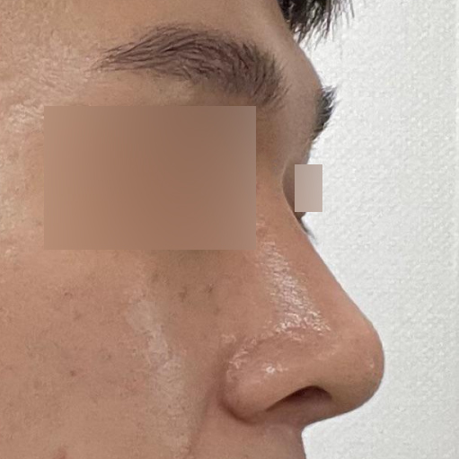 Би Вэбэрс гоо сайхны мэс заслын эмнэлэгт хамрагдаж, мэс засал хийлгэснээс хойш 2 сар болж байна.