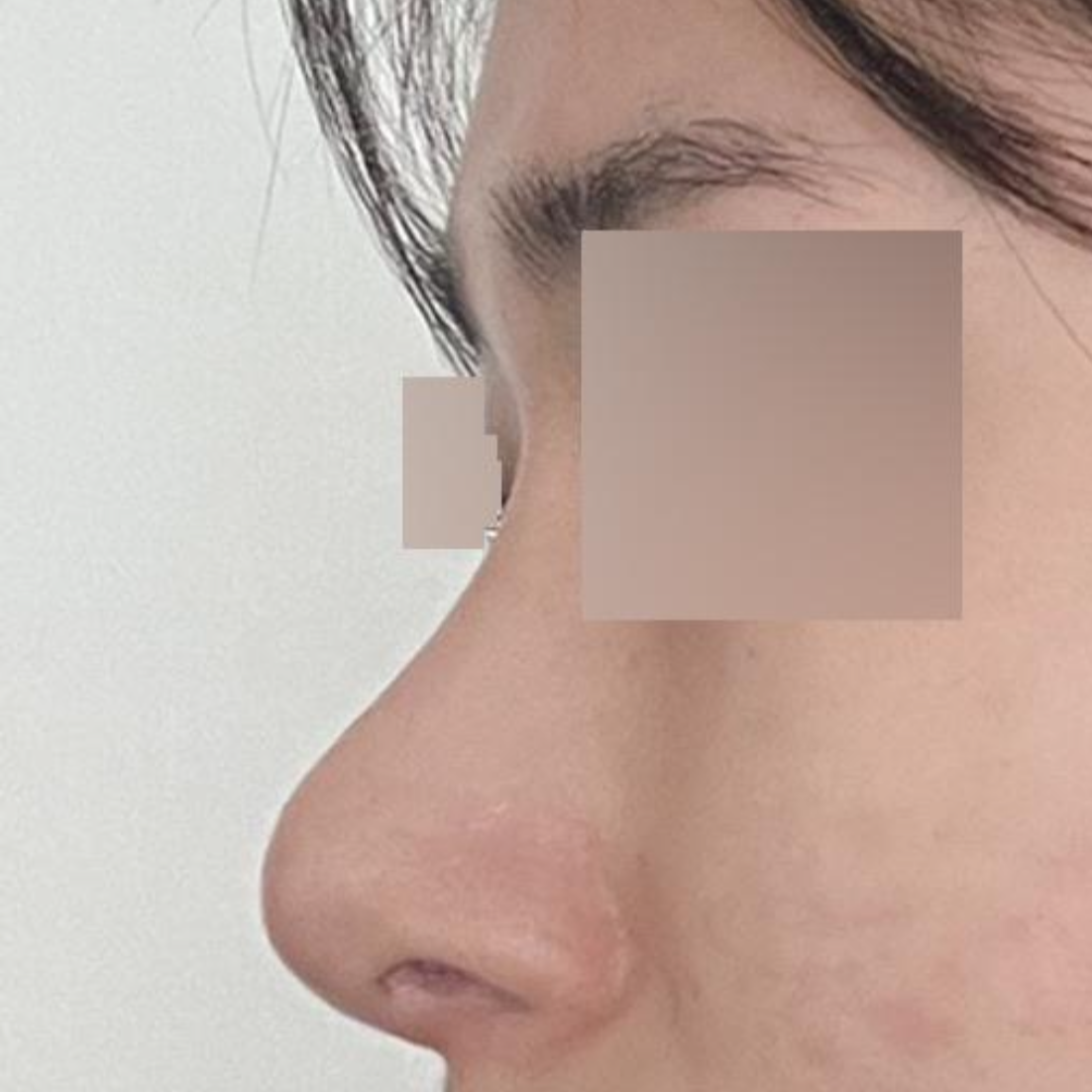 Виверс гоо сайхны мэс заслын эмнэлэгт хамар засварлуулснаас хойш хоёр сар болж байна.