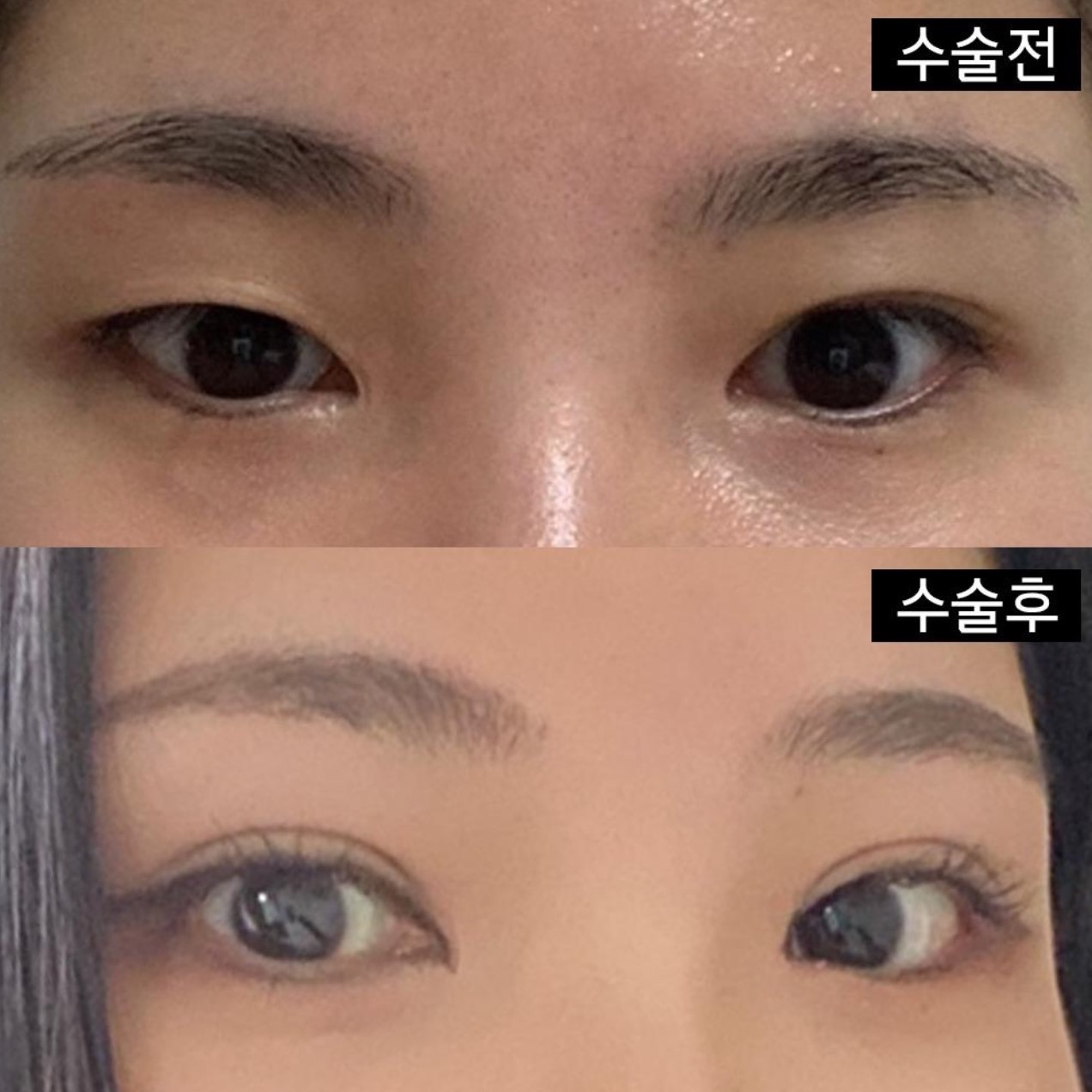 Хэрэв та давхар зовхины мэс засал, нүдний дахин мэс засал хийлгэх гэж байгаа бол заавал очиж үзэхийг зөвлөж байна