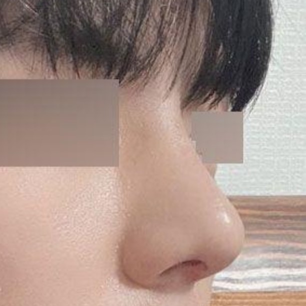 Хамар битүүрэх мэс засал болон өөрийгөө арчлах зорилгоор хагалгаанд орсон.