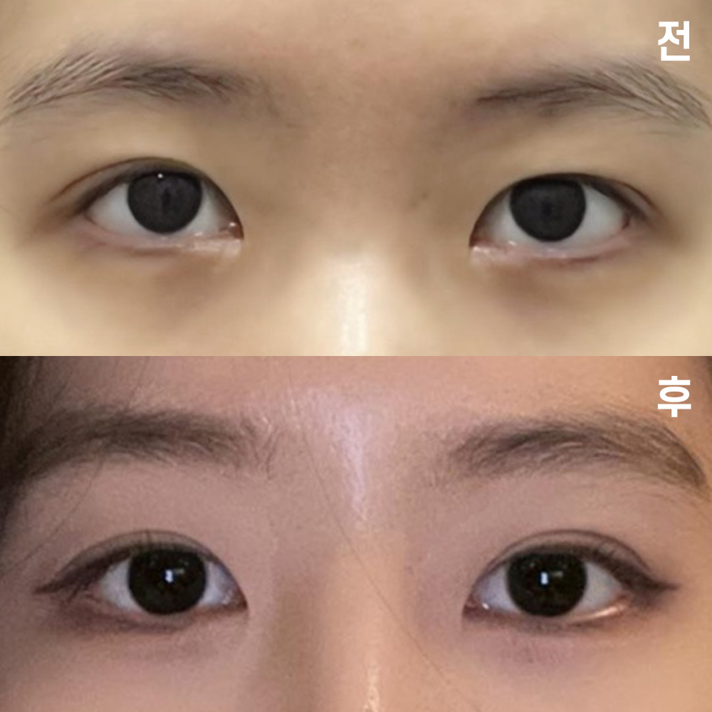 Виверс гоо сайхны мэс заслын эмнэлэгт хагалгаанд ороод 1 сар боллоо~! 