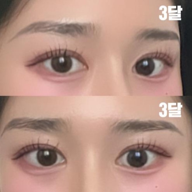 Би давхар зовхины хагалгаанд ороод 3 сар болж байна.