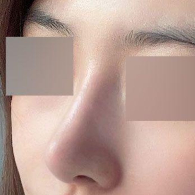 Хамрын дахин мэс засал хийлгэсний дараа ямар нэгэн асуудалгүй 3 сар өнгөрлөө ㅎㅎ