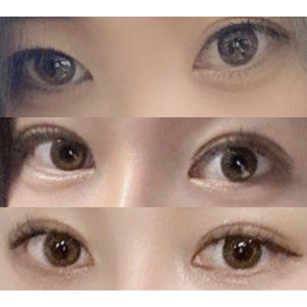 Нүдний дахин хагалгаа амжилттай болж, маш гоё болсон!