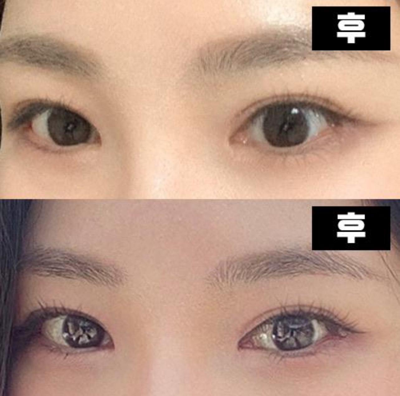 Хэрэв та давхар зовхины мэс засалд санаа зовж байгаа бол би үнэхээр санал болгож байна ~