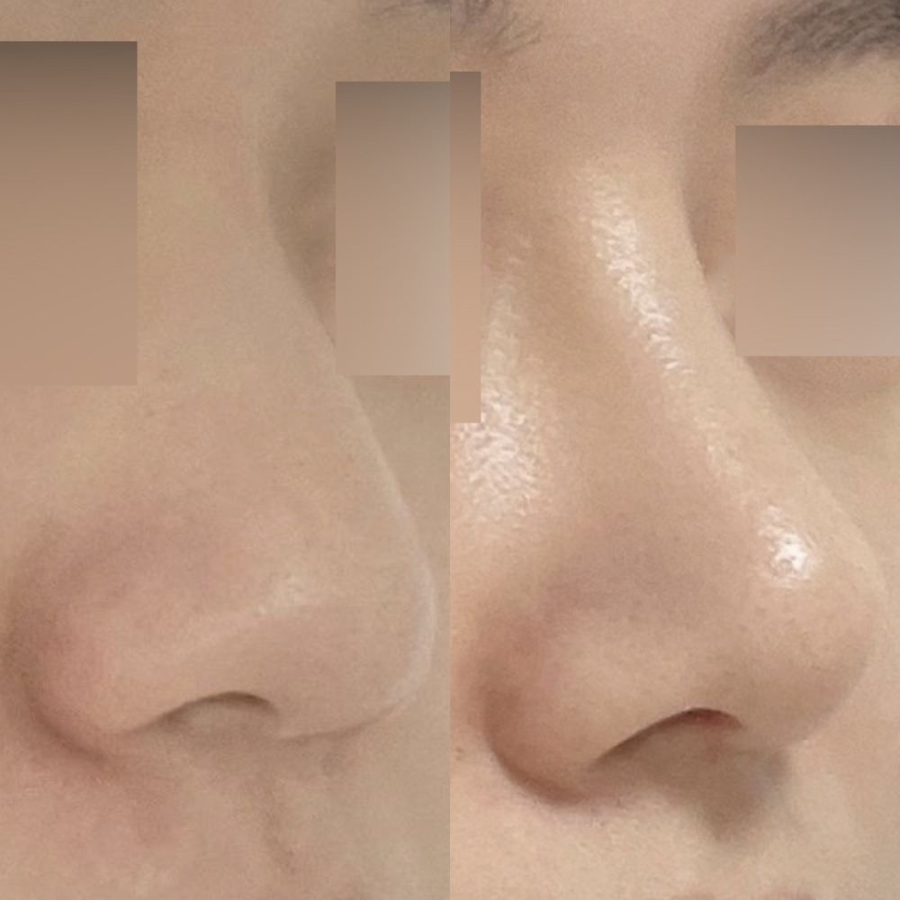 Би хамар томруулах мэс заслыг имплантгүйгээр хийлгэсэн