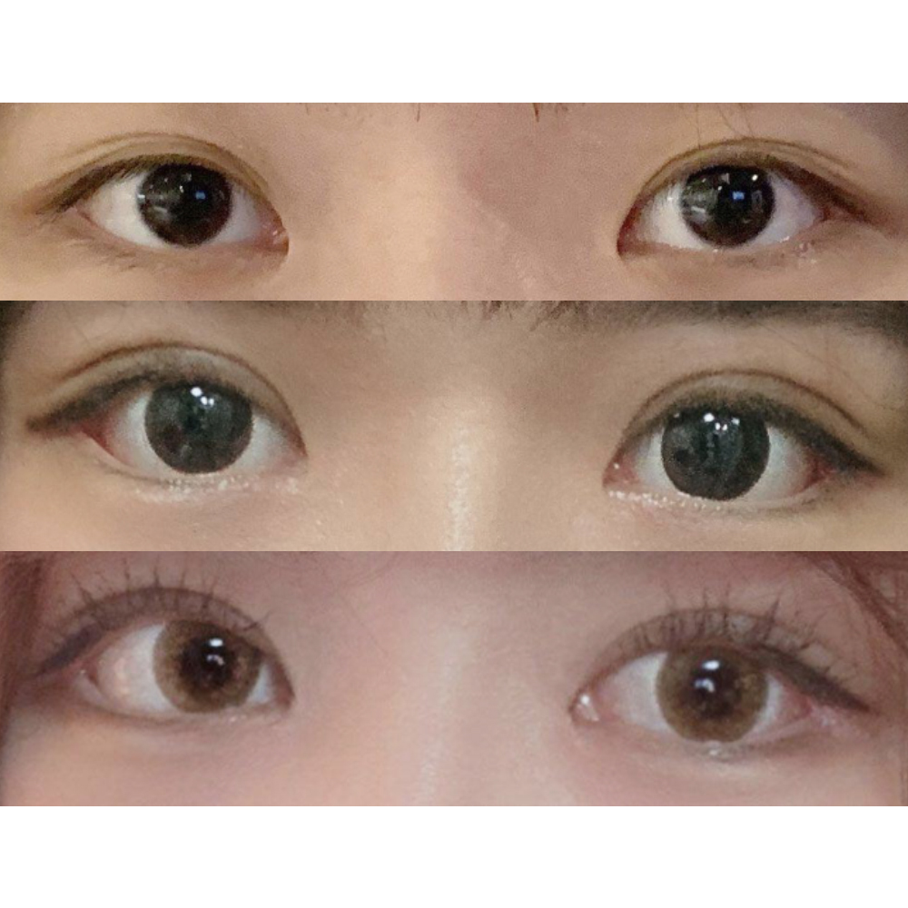 Ар шилэн мэс засал + байгалийн наалдац + нүдний хэлбэр засах мэс заслын дараах сэтгэгдэл!