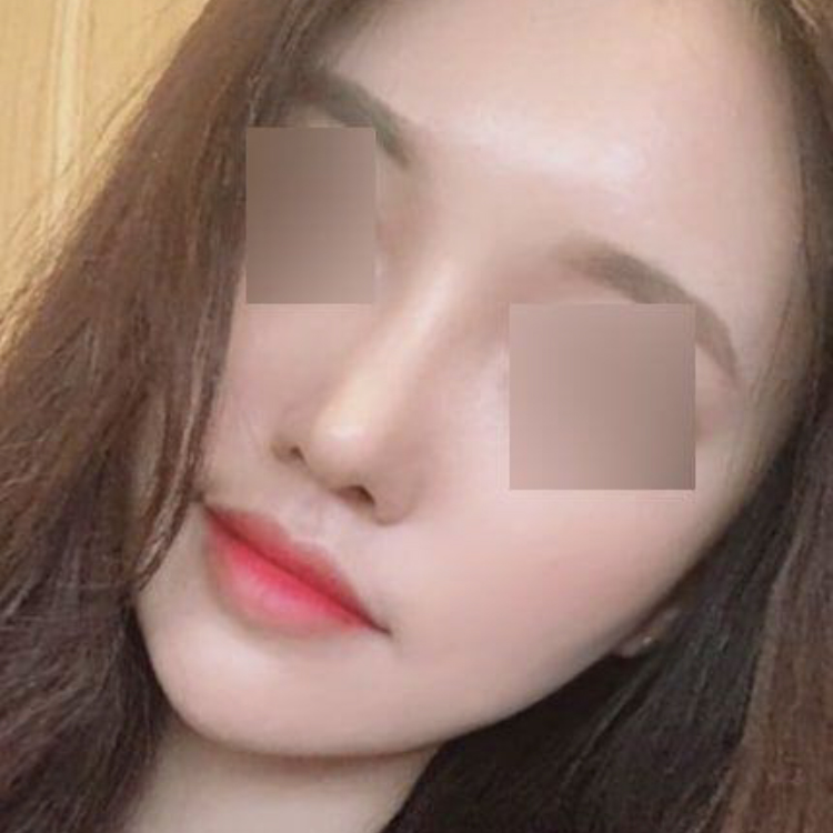 Би Виверсэд хамрын хагалгаанд ороод 3 сар боллоо!