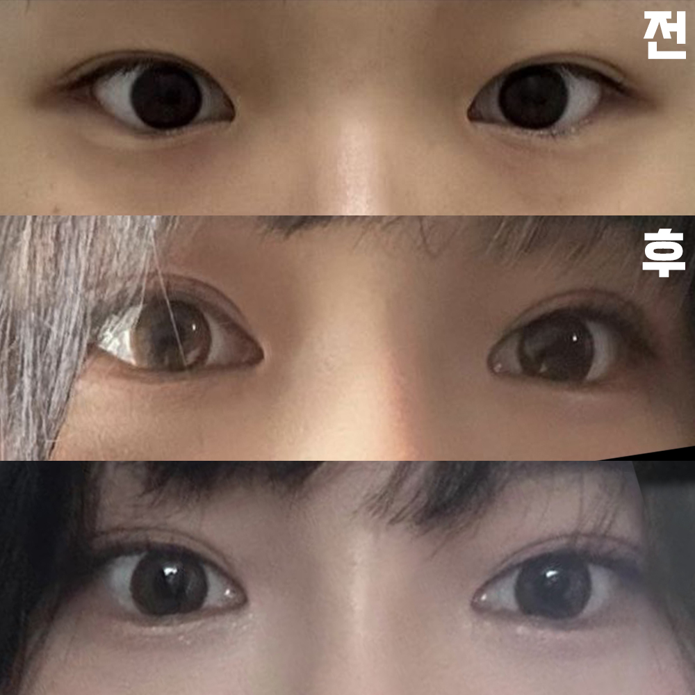 Үр дүнд нь маш их сэтгэл хангалуун байгаадаа маш их баяртай байна. Эмчдээ баярлалаа!!