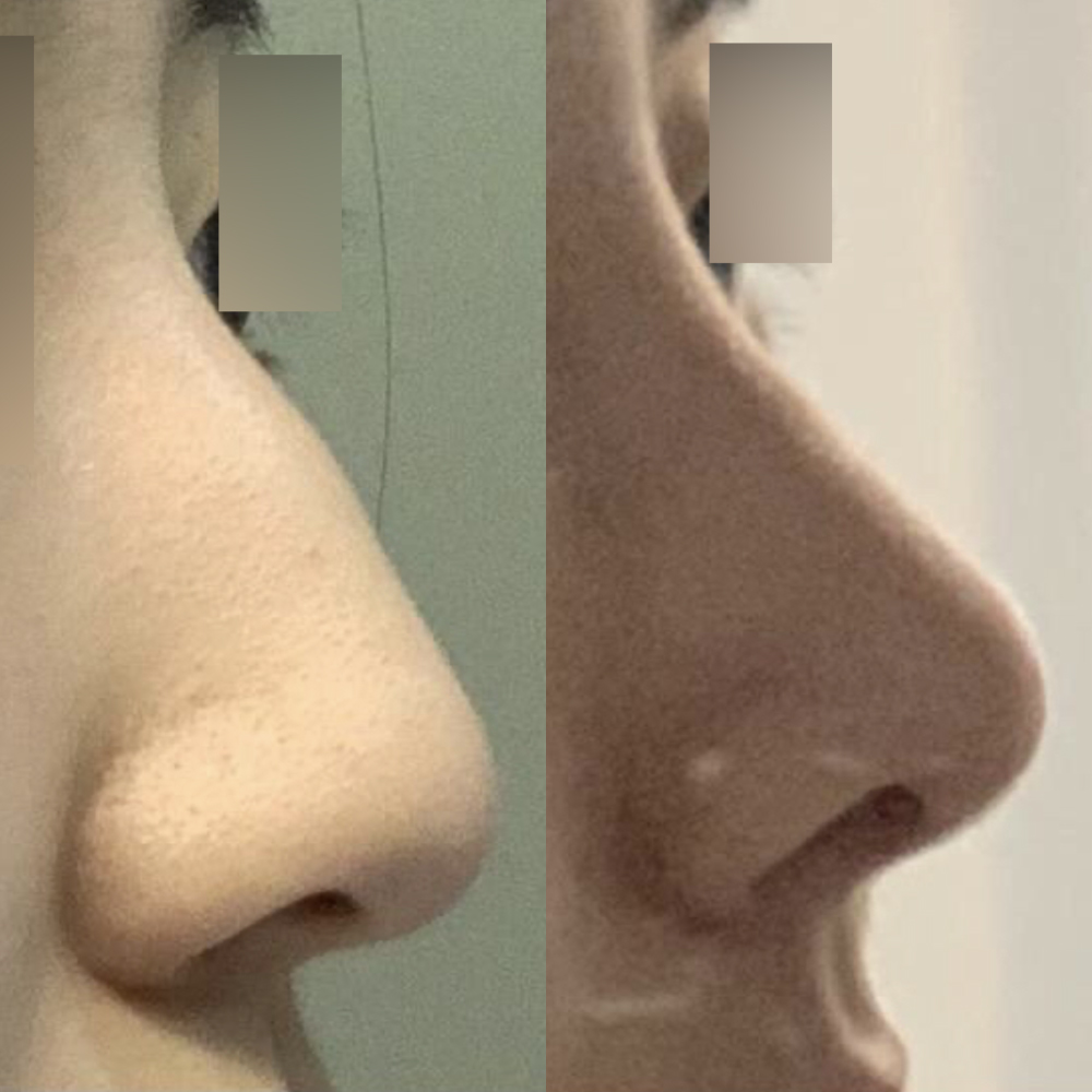 Бөөрөнхий хамартай хагалгаанд орсон шүүㅎㅎ