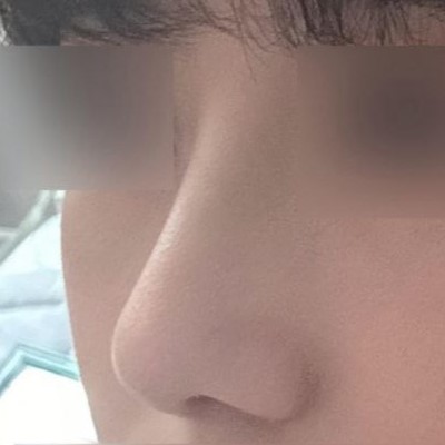 Анхны хамарны мэс засал хэдий ч маш их 3728299393829% сэтгэл хангалуун байна