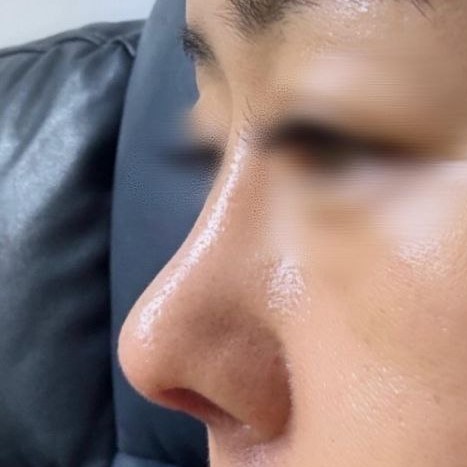 Хамрын үзүүр доошоо унждаг байсан нь санаа зовоож байсан ч хамрын үзүүртэй болсондоо маш их баяртай байна ^^