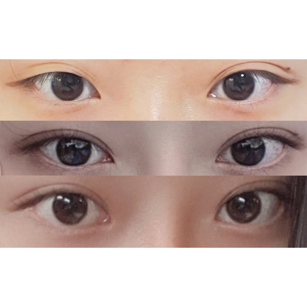 Нүд, хамраа хамт мэс засалд оруулсан шүүㅎㅎ