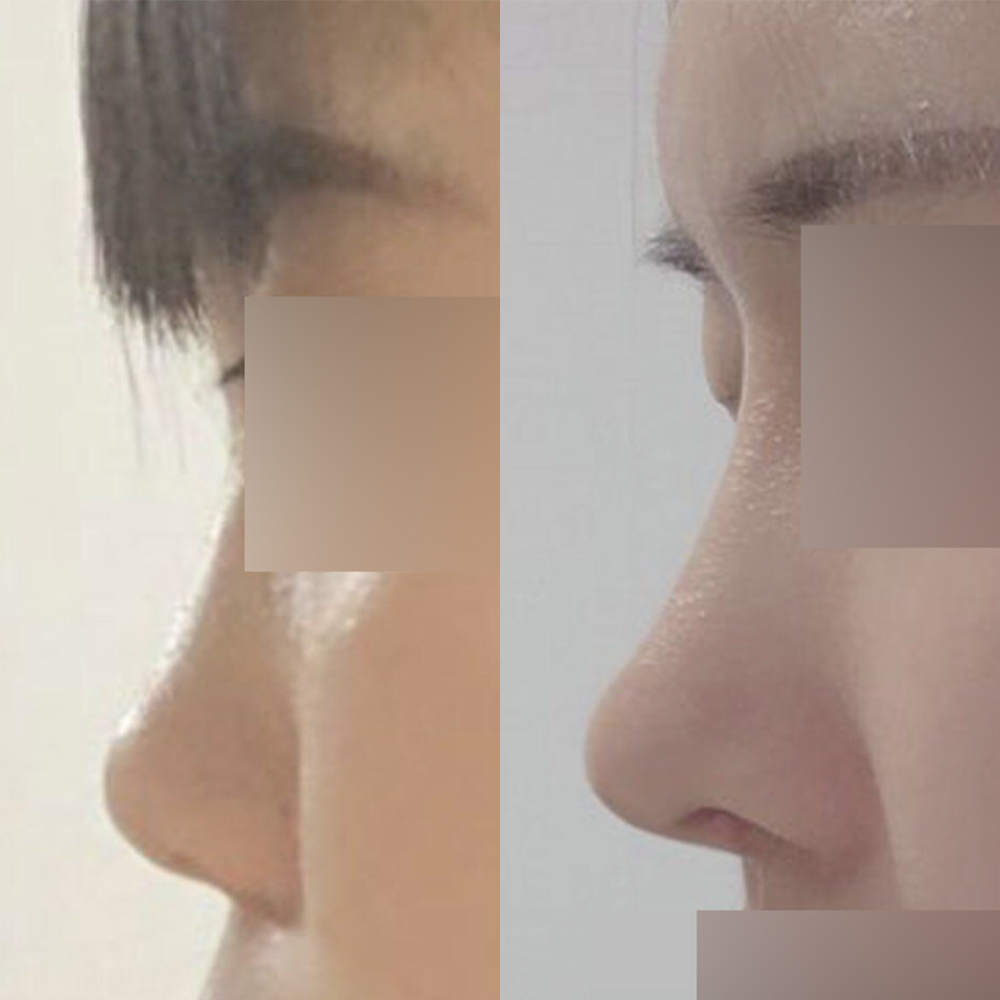 Нүд, хамрын мэс засал хийлгэснээс хойш 8 сар болжээ!