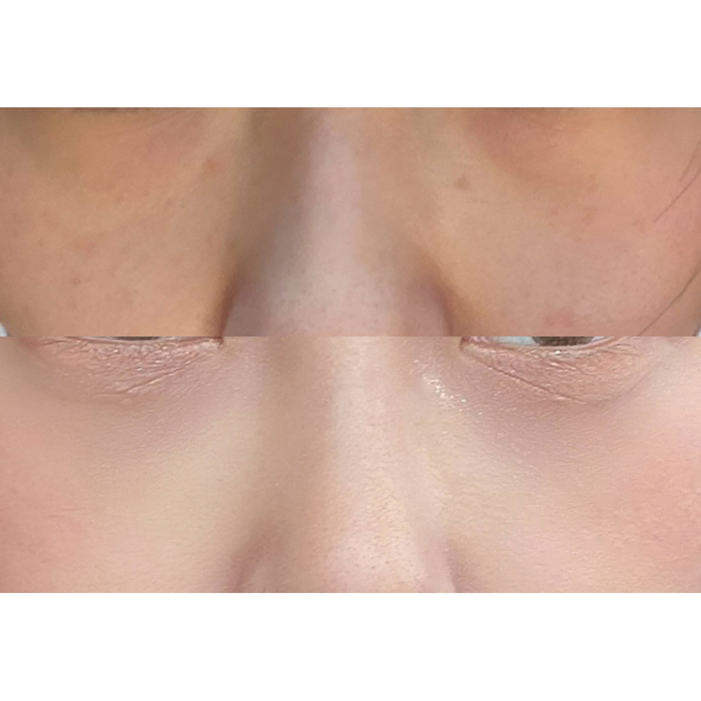 Я ядарсан нүдний доорх өөхний асуудлыг шийдвэрлэсэн шүү хэхэ