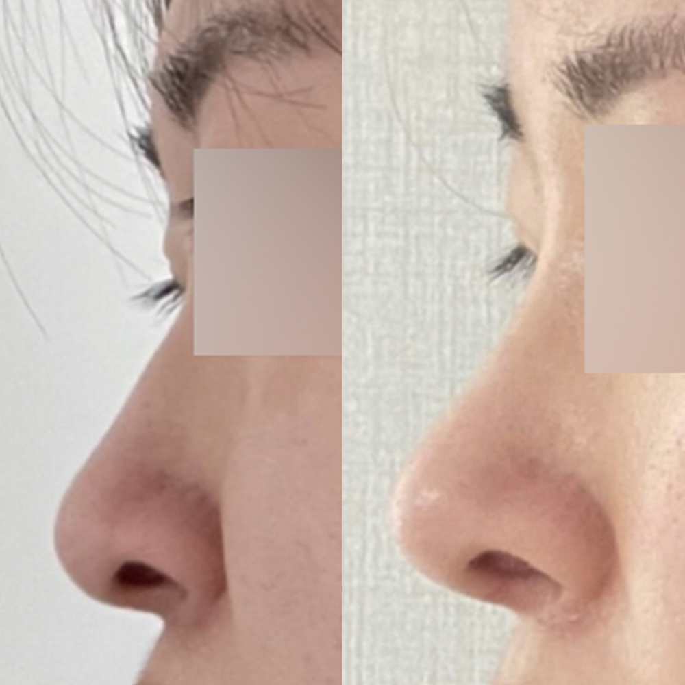 Удаан хугацаанд намайг зовоож байсан хамараа эцэст нь мэс засалд орууллаа ~