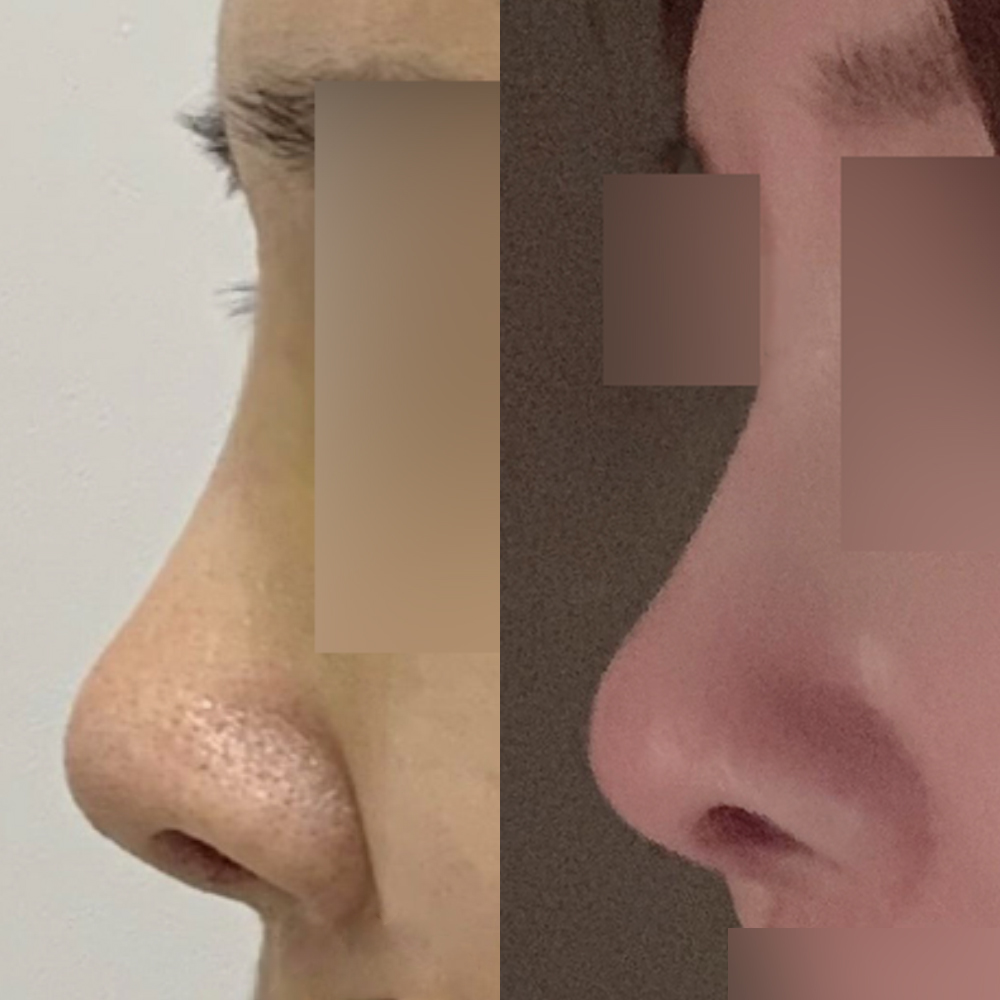 Би 5 жилийн өмнө гэнэт хамарны хагалгаанд орсон:-)))