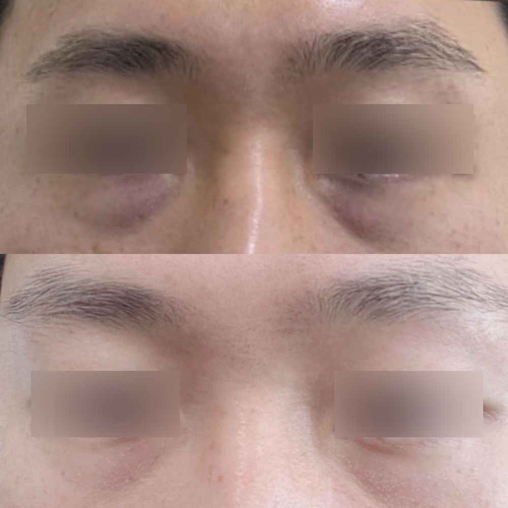 Нүдний доорх өөх тосыг дахин байрлуулсны дараах 2 сарын тойм :)